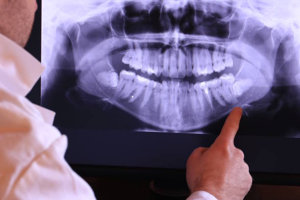 Best Emergency Dental Extractions in Chapel Hill, NC