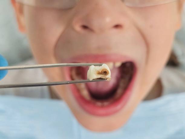Best Pediatric Emergency Dentist in Chapel Hill, NC